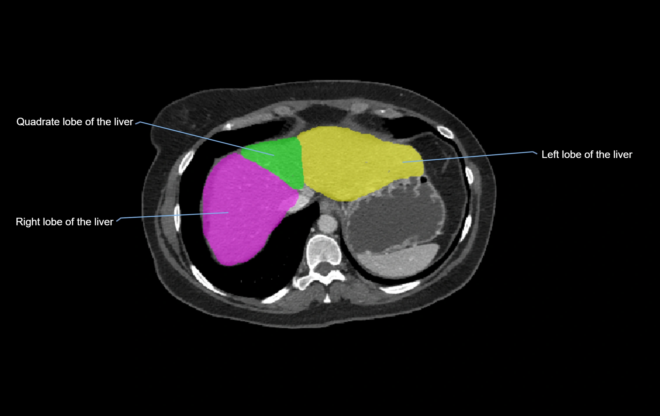 CT lliver lobes axial cross sectional anatomy labelled image -00068.webp